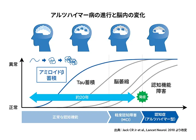 アルツハイマー病の進行と脳内の変化のグラフ