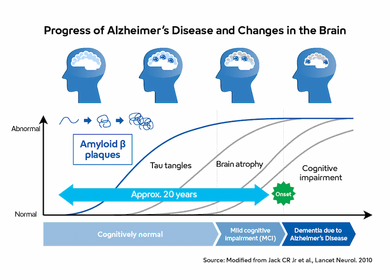 Progress of Alzheimer's Disease and Changes in the Brain