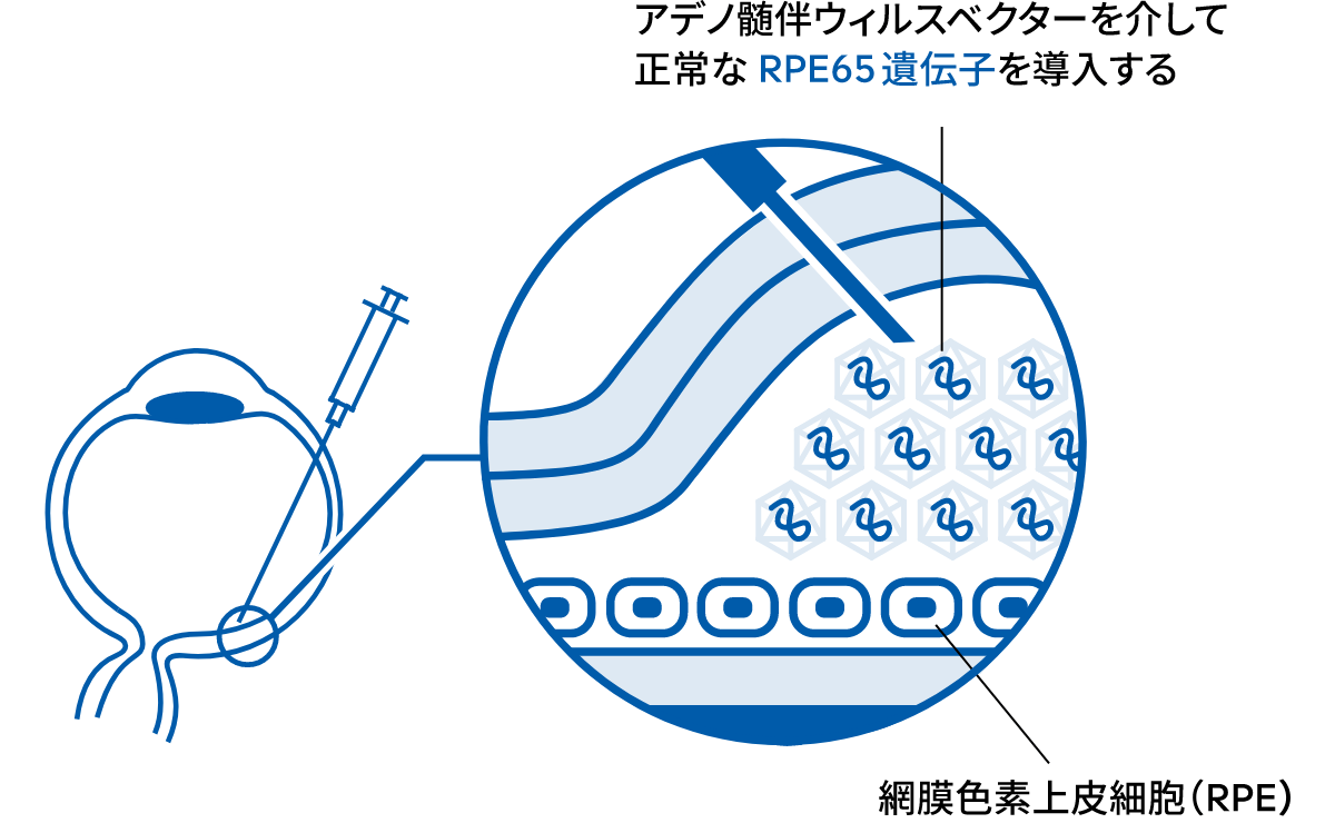 遺伝子治療の一例のイラスト