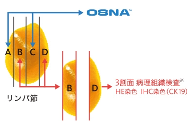 乳がんリンパ節転移検査に関するデータ2
