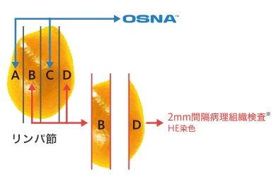 胃がんリンパ節転移検査に関するデータ1