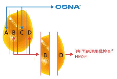 非小細胞肺がんリンパ節転移検査に関するデータ1